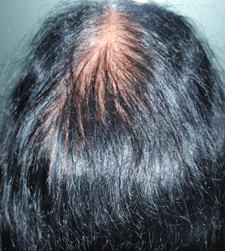 Before treatment